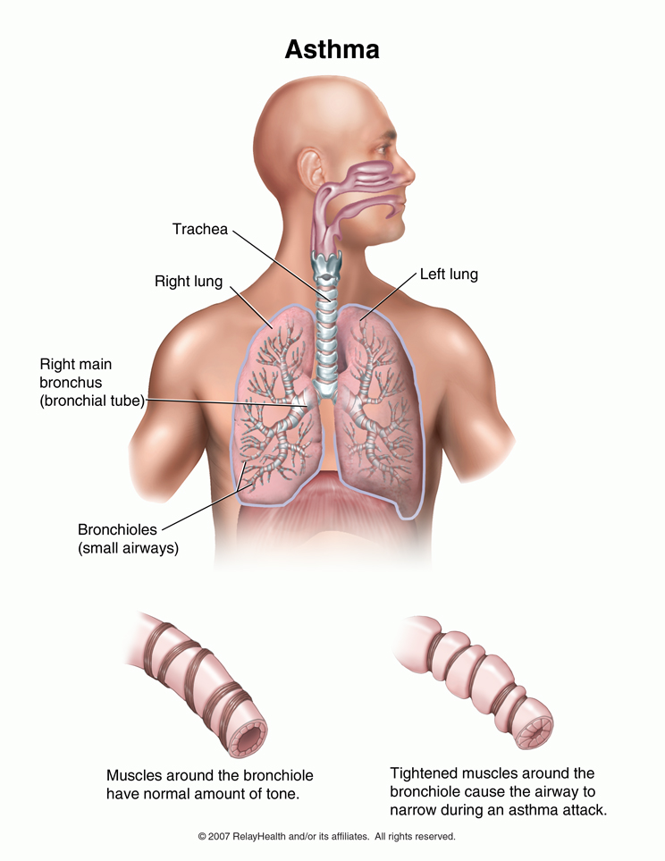 Asthma: Illustration