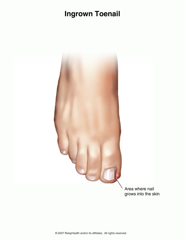 Ingrown Toenail: Illustration