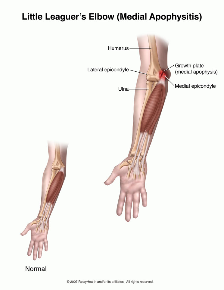 Little Leaguer's Elbow: Illustration