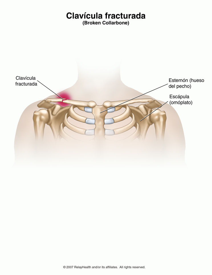 Clavícula fracturada: ilustración