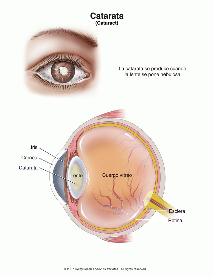 Catarata: ilustración