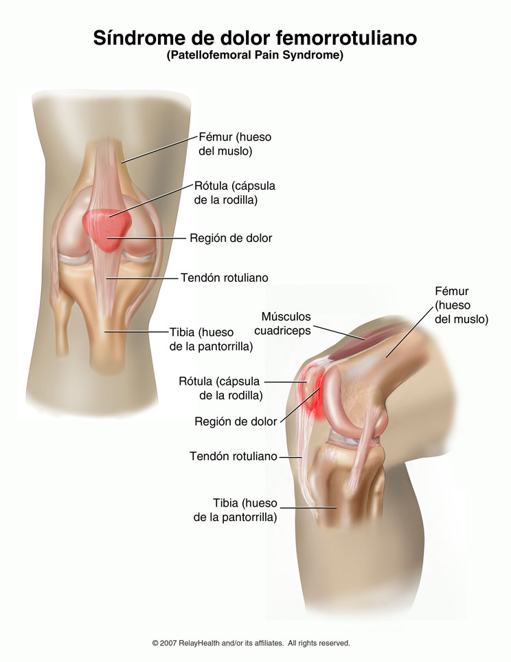 Síndrome de dolor femorrotuliano: ilustración