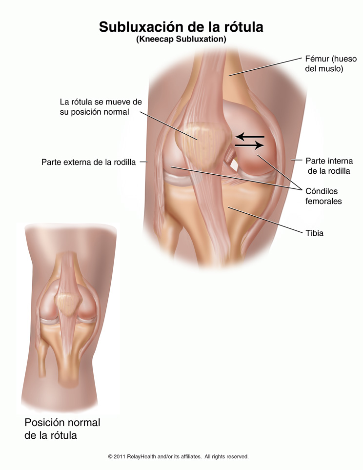 Subluxación de la rótula: ilustración