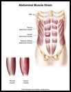 Thumbnail image of: Abdominal Muscle Strain: Illustration