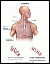 Thumbnail image of: Asthma: Illustration