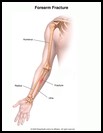 Thumbnail image of: Forearm Fracture: Illustration