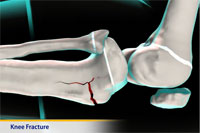 Thumbnail image of: Knee Fracture (pediatric)