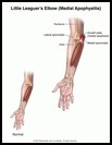 Thumbnail image of: Little Leaguer's Elbow: Illustration