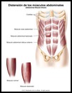 Thumbnail image of: Distensión de los músculos abdominales: ilustración