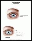 Thumbnail image of: Conjuntivitis: ilustración