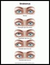 Thumbnail image of: Strabismus: Illustration