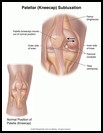 Thumbnail image of: Kneecap Subluxation: Illustration