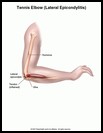 Thumbnail image of: Tennis Elbow: Illustration