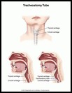 Thumbnail image of: Tracheostomy Tube: Illustration