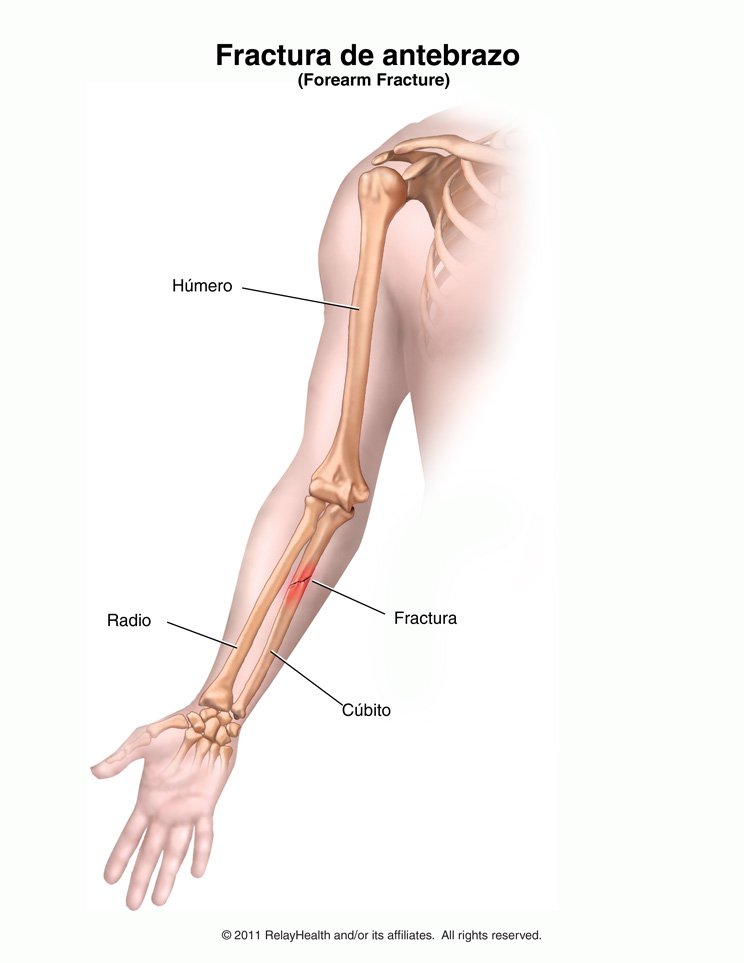 Fractura de antebrazo: ilustración