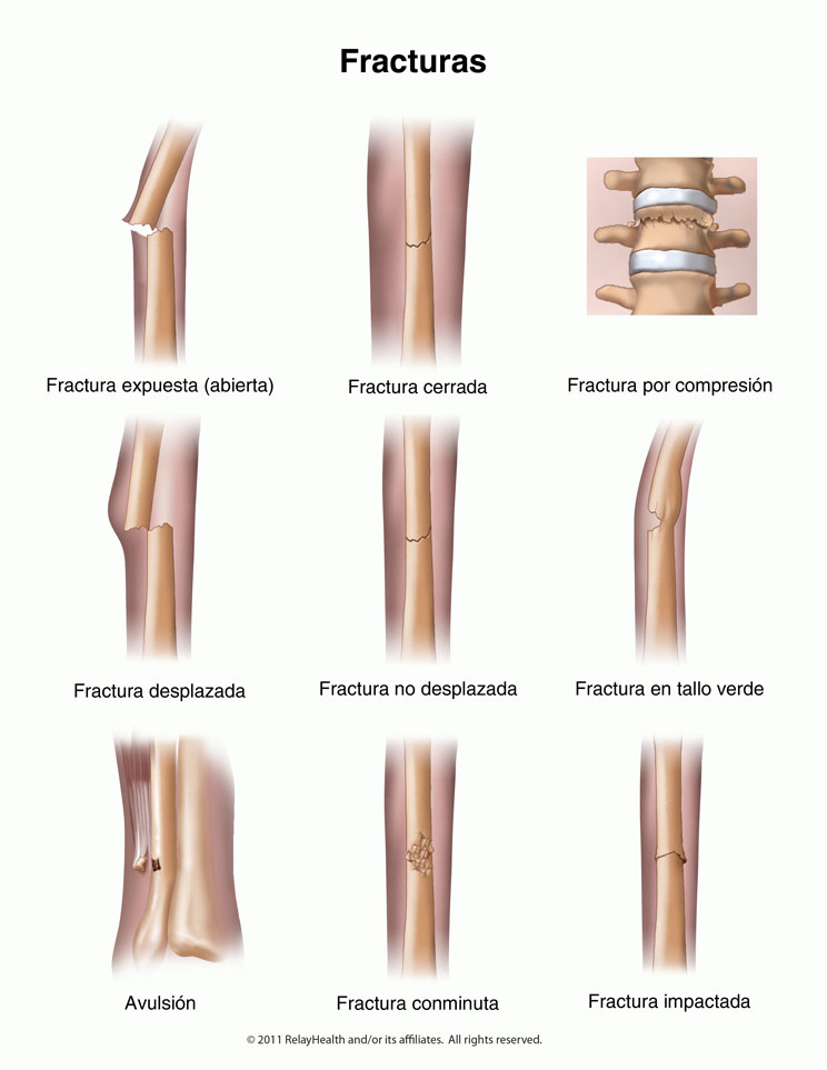 Fracturas: Ilustración