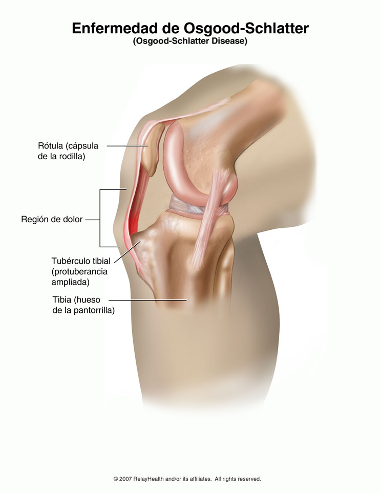 Enfermedad de Osgood-Schlatter: ilustración