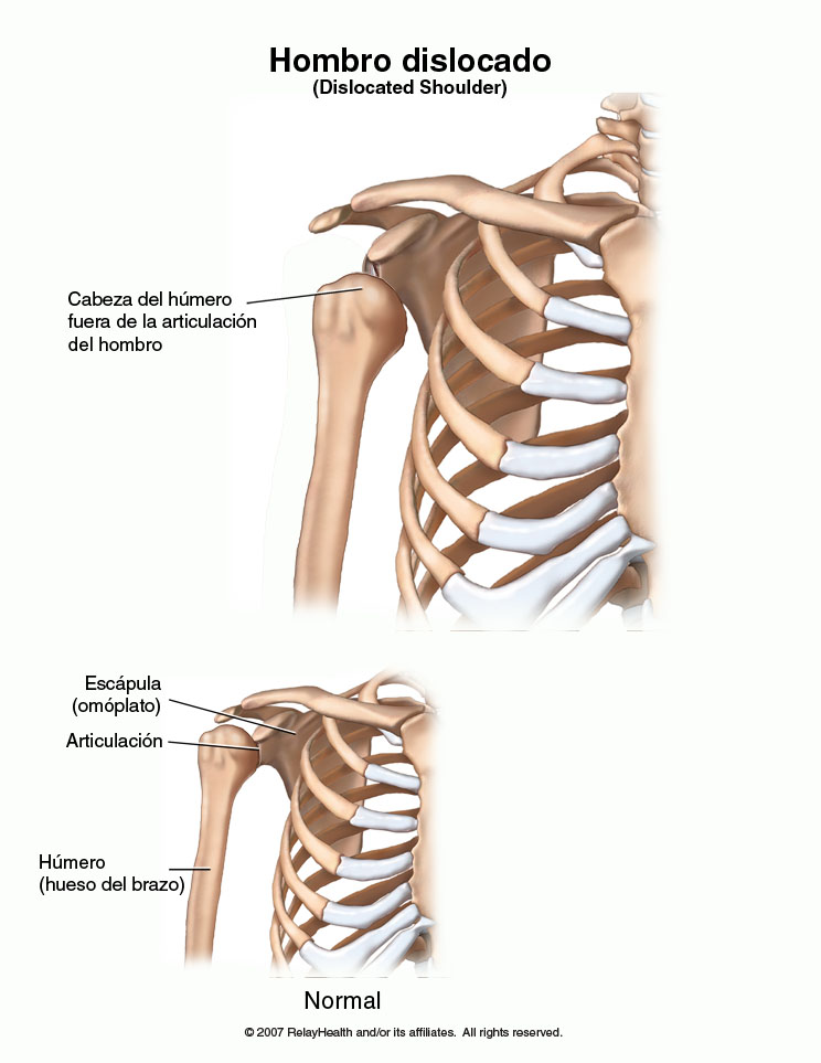 Hombro dislocado: ilustración
