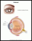 Thumbnail image of: Cataract: Illustration