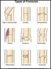 Thumbnail image of: Fracture Types: Illustration