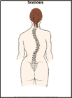 Thumbnail image of: Scoliosis: Illustration