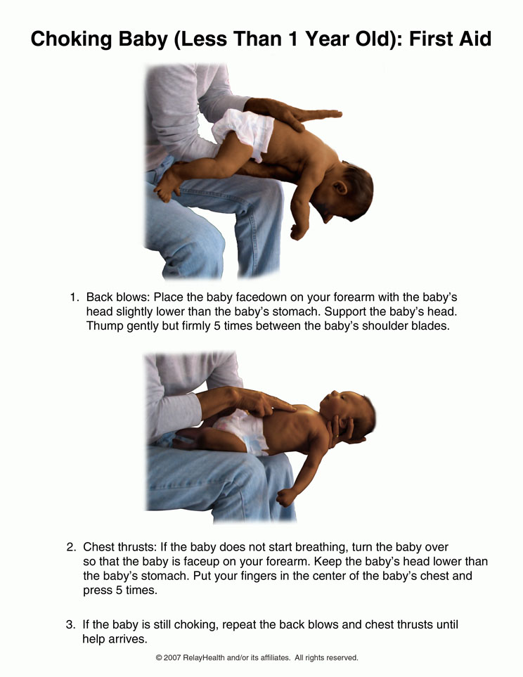 Choking Baby (Less Than 1 year Old): First Aid: Illustration