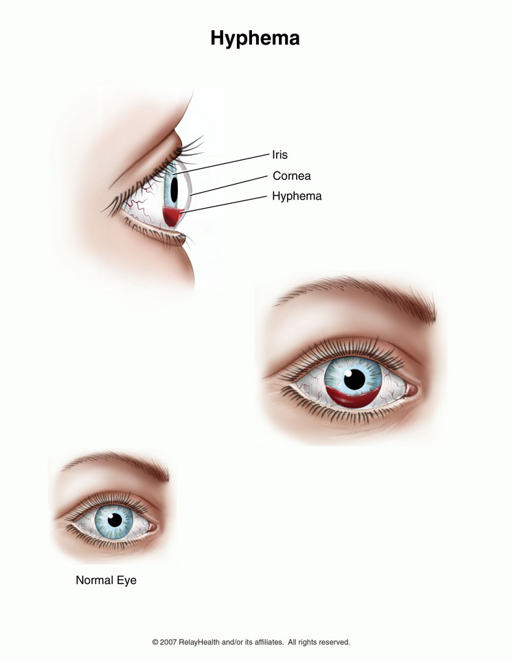 Hyphema: Illustration