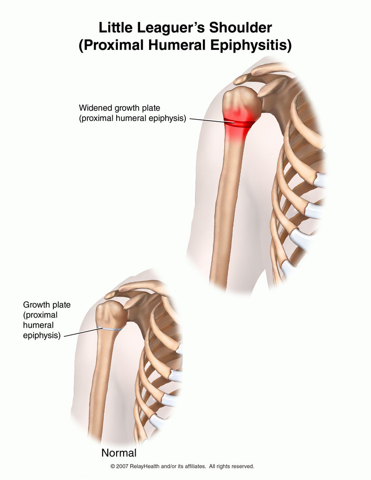 Little Leaguer's Shoulder: Illustration