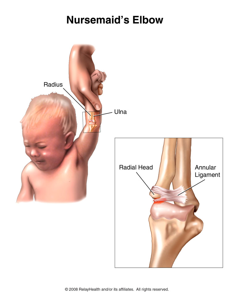 Nursemaid's Elbow: Illustration