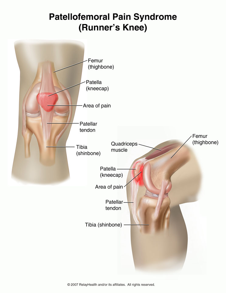 Runner's Knee: Illustration