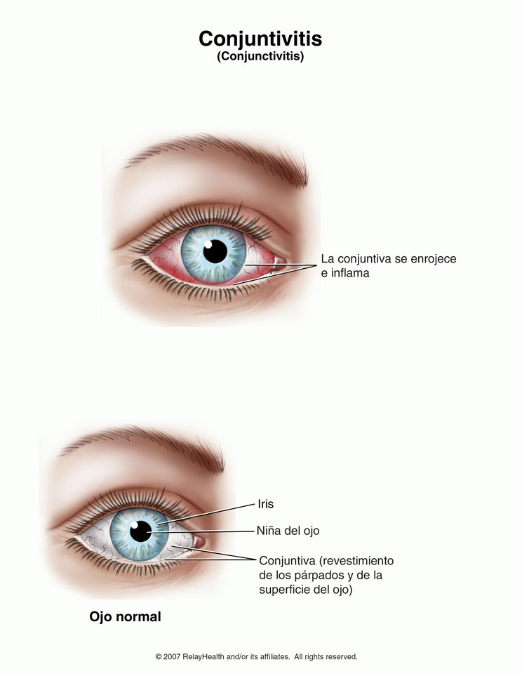 Conjuntivitis: ilustración