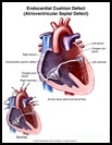 Thumbnail image of: Endocardial Cushion Defect: Illustration