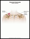 Thumbnail image of: Clavícula fracturada: ilustración