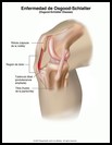 Thumbnail image of: Enfermedad de Osgood-Schlatter: ilustración