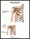 Thumbnail image of: Hombro dislocado: ilustración